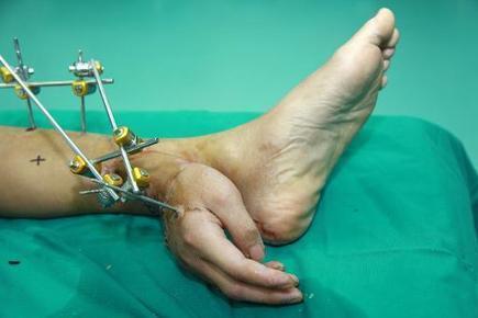 La main d'un Chinois greffée provisoirement sur sa jambe avant de retrouver son poignet | KILUCRU | Scoop.it