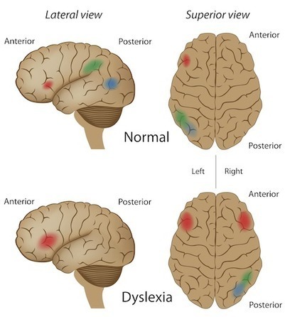 Neurofeedback for Dyslexia, Dysgraphia, Dysprax...