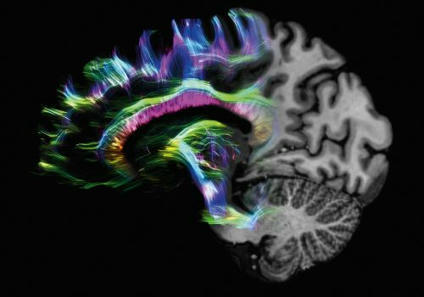 Diagn&oacute;stico por imagen en la detecci&oacute;n precoz del Alzheimer | Alzheimer y m&aacute;s (Bolet&iacute;n n&ordm; 80) | Scoop.it