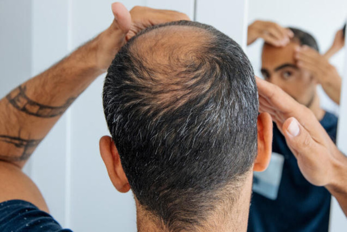 'It's where you're balding that counts': What your hairline can reveal about your health | The Health Report | Scoop.it
