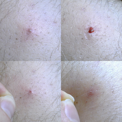 Ingrown Hair Causes Treatment Pr