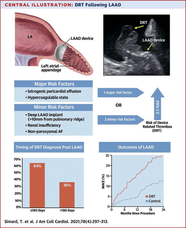 Predictors of Device-Related Thrombus Following Percutaneous Left Atrial Appendage Occlusion | Transcatheter Treatment of Mitral Regurgitation | Scoop.it