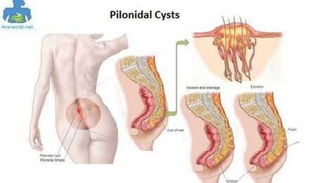 Cyst Treatment In Lahore In Treatment With Natural Herbs Scoop It