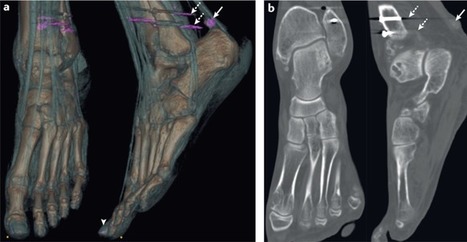 Are the days of missed or delayed diagnosis of gout over? | Rheumatology-Rhumatologie | Scoop.it