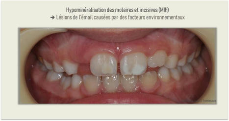 Des MIH ? Oui, on en voit de plus en plus"👀Les dentistes constatent de plus en plus d'enfants présentent des tâches blanches ou brunes | Toxique, soyons vigilant ! | Scoop.it