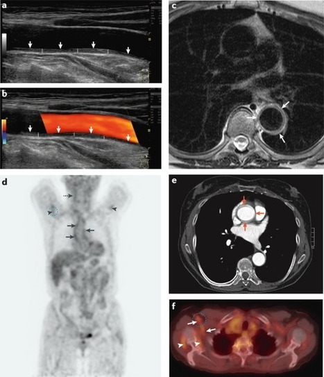 Monitoring and long-term management of giant cell arteritis and polymyalgia rheumatica | Rheumatology-Rhumatologie | Scoop.it