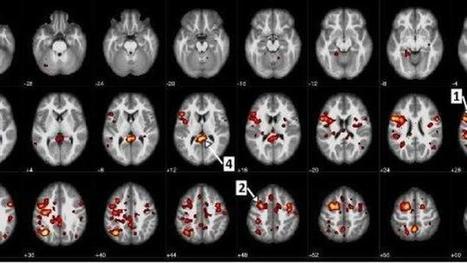 Mieux diagnostiquer les cas de schizophrénie grâce à l'intelligence artificielle | Médecine  Cerveau Intelligence | Scoop.it