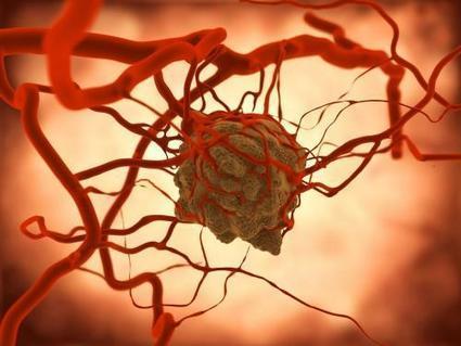 #Sante #Cancers douloureux : 5 choses à savoir #AFSOS  | autour du CANCER | Scoop.it