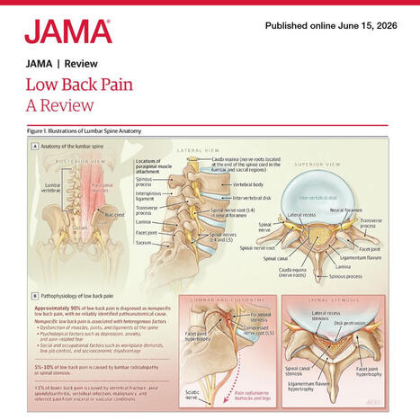 Low Back Pain: Epidemiology and Treatment Options | JAMA posted on the topic | Rheumatology-Rhumatologie | Scoop.it