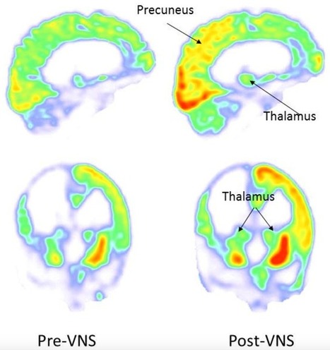 Kurzweil : "Neuroscientists restore vegetative-state patient’s consciousness... | Ce monde à inventer ! | Scoop.it