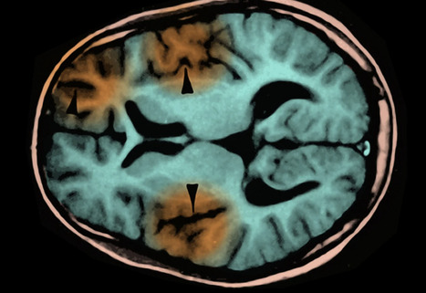 Measles Death Shows How Virus Can Hide in the Brain for Years | Virus World | Scoop.it