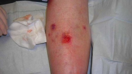 Spray-on skin speeds healing of venous leg ulcers | Longevity science | Scoop.it