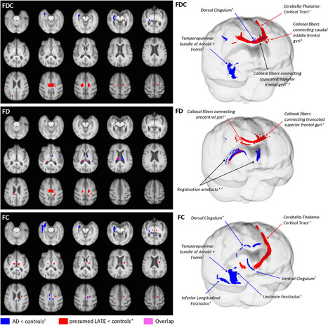 Une méthode d’analyse en IRM de diffusion pour étudier les altérations des faisceaux de substance blanche dans la maladie d’Alzheimer et la pathologie LATE ? | Life Sciences Université Paris-Saclay | Scoop.it