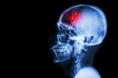 How Serious Is Cranial Nerve Damage? | Personal Injury Attorney News | Scoop.it