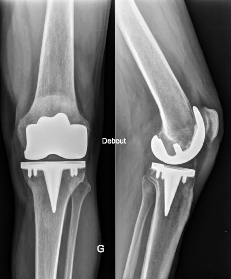 La vie après une opération du genou-l'évolution - un knol de Gust MEES | L'arthrose | Scoop.it