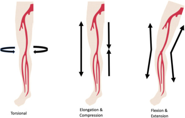 State-of-the-Art Endovascular Therapies for the Femoropopliteal Segment: Are We There Yet? | Interventional Cardiology | Scoop.it