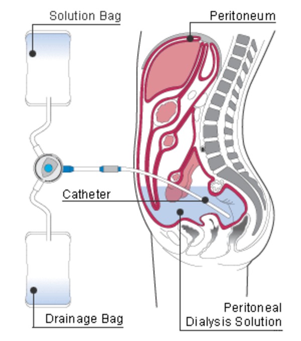 History of Peritoneal Dialysis | Peritoneal dialysis | Scoop.it