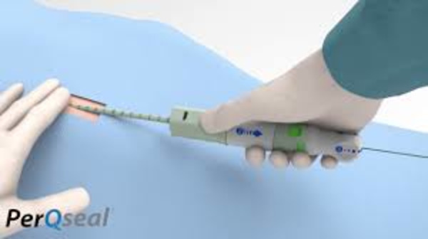 First large bore venous patient treated with PerQseal Elite vascular closure system | Transcatheter Treatment of Mitral Regurgitation | Scoop.it