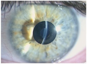 Implante intracorneal colocado con láser femtosegundo para la compensación de la presbicia | Salud Visual (Profesional) 2.0 | Scoop.it