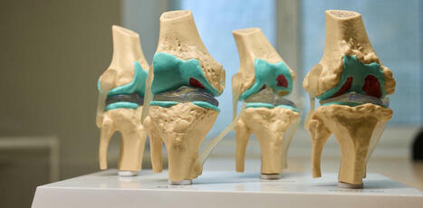 What are the key risk factors for developing knee osteoarthritis? We reviewed the evidence | Hospitals and Healthcare | Scoop.it