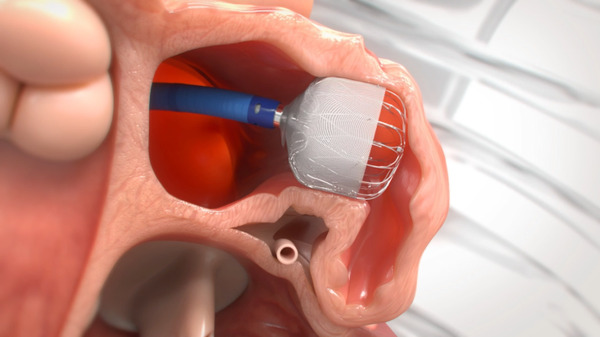 Comparative Assessment of Percutaneous Left-Atrial Appendage Occlusion (LAAO) Devices—A Single Center Cohort Study | Interventional Cardiology | Scoop.it