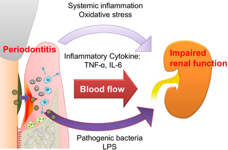 Prevalence of chronic periodontitis in patients undergoing peritoneal dialysis and its correlation with peritoneal dialysis-related complications | Peritoneal dialysis | Scoop.it