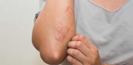 Common skin rashes and what to do about them | Physical and Mental Health - Exercise, Fitness and Activity | Scoop.it