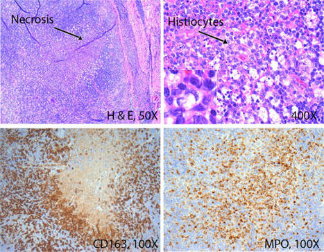 Kikuchi-Fujimoto disease is mediated by an aberrant type I interferon response | Modern Pathology | Hematology | Scoop.it