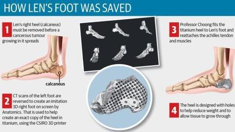 Australian Doctors Save Cancer Patient’s Leg From Amputation With 3D Printed Heel Bone | 21st Century Innovative Technologies and Developments as also discoveries, curiosity ( insolite)... | Scoop.it