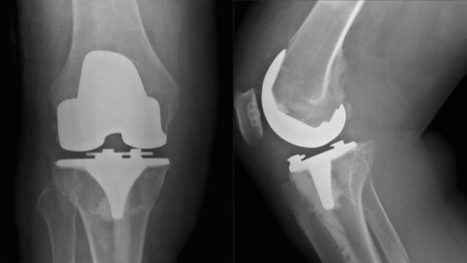 Zimmer Persona Knee Replacement Lawsuit & Complications – Defects Lawyer | Rhode Island Lawyer, David Slepkow | Scoop.it