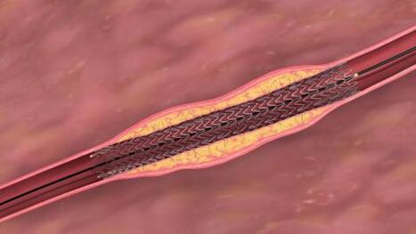 Trial Establishes Benefit of Drug-Eluting Stent in PAD | Interventional Cardiology | Scoop.it
