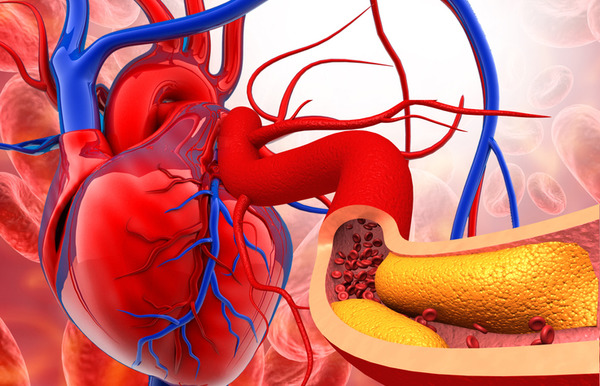 Drug-coated balloon-only strategy for percutaneous coronary intervention of de novo left main coronary artery disease: the importance of proper lesion preparation | Interventional Cardiology | Scoop.it