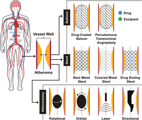 Outcomes of drug-coated balloon combined with stenting vs. stenting alone in the treatment of femoropopliteal artery lesions requiring bailout stenting&nbsp; | Critical Limb-Threatening Ischemia (CLTI) | Scoop.it