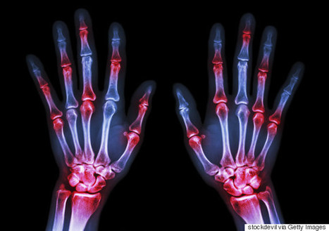 The Nano Science Advance That's Improving The Lives Of Arthritis Sufferers | 21st Century Innovative Technologies and Developments as also discoveries, curiosity ( insolite)... | Scoop.it