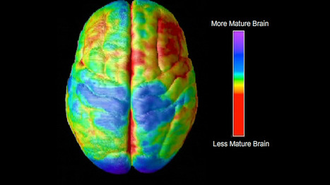 The music of the (hemi)spheres sheds new light on schizophrenia | Science News | Scoop.it