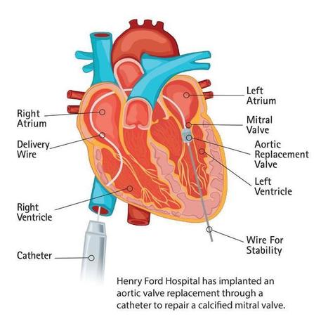 Sapien Aortic Valve Used to Replace Mitral Valve | Transcatheter Treatment of Mitral Regurgitation | Scoop.it