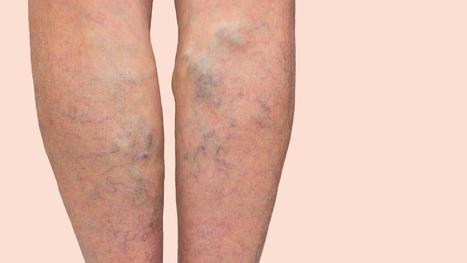 Varicose veins may be genetically more likely in taller people | Anthropometry and Kinanthropometry | Scoop.it