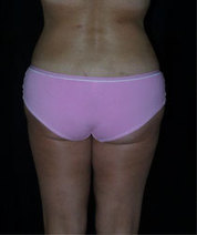 Facts About Liposuction | Navigating Healthcare | Medical and Health | Scoop.it