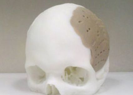 Imprimé en 3D, un implant remplace 75 % du crâne d’un Américain | Veille sur les technologies d'impression 3D | Scoop.it
