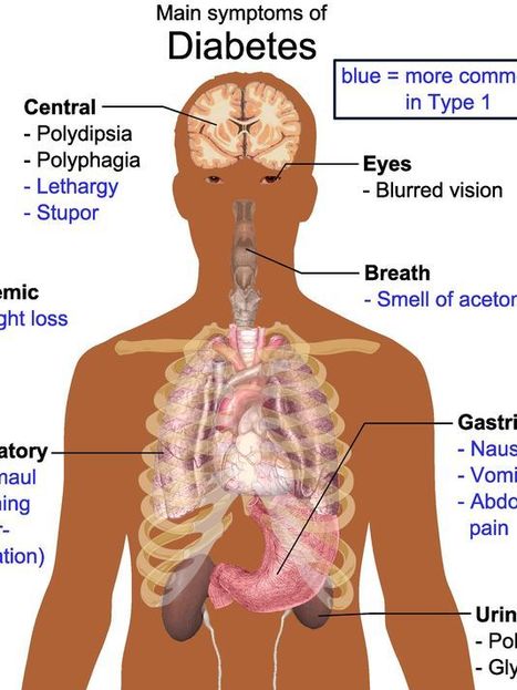 Diabetes can develop without symptoms | Daily realities of diabetic patients | Scoop.it