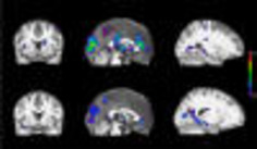 How genetics shape our addictions: Genes predict the brain's reaction to smoking | Kinsanity | Scoop.it