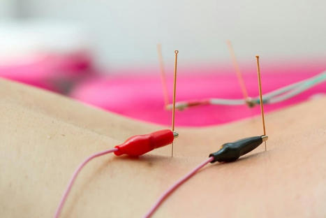 How Electroacupuncture Can Help Your Musculoskeletal System | Call: 915-850-0900 | Chiropractic + Wellness | Scoop.it