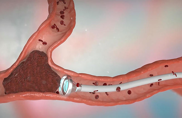 Artedrone tries robots and magnets for autonomous thrombectomy | Neurovascular Intervention | Scoop.it