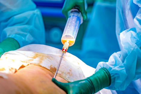 History of Liposuction | Navigating Healthcare | Medical and Health | Scoop.it