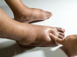 Swollen Ankles in The Elderly | Foot Doctor houston | Scoop.it