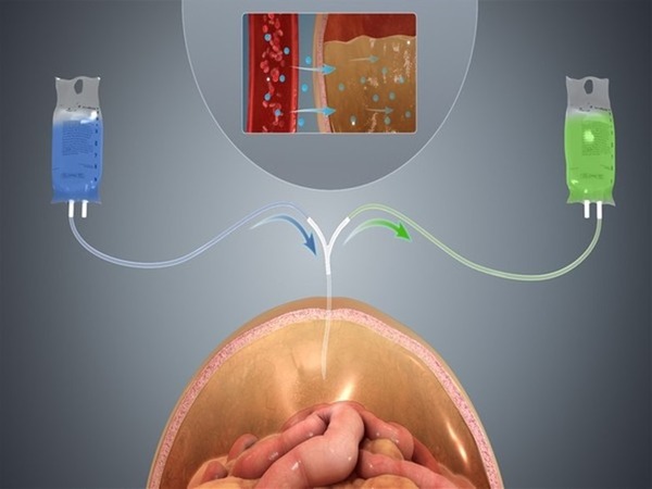 Wearable artificial kidney may improve peritoneal dialysis | Peritoneal dialysis | Scoop.it