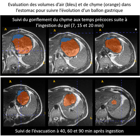 FOCUS PLATEFORME : Lutte contre l’obésité : étude exploratoire par IRM de la dynamique d’un ballon gastrique éphémère | Life Sciences Université Paris-Saclay | Scoop.it