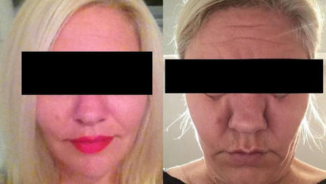 Patients report side effects after popular cosmetic procedure to dissolve facial fillers with unregulated 'off-label' drug, | Avoid Internet Scams and ripoffs | Scoop.it