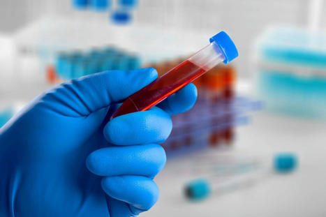 Un test sanguin détecte le #CancerColorectal avec une précision de 83 % #Dépistage @Inserm #Diagnostic | autour du CANCER | Scoop.it