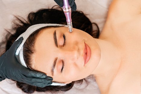 The Ultimate Guide to Microneedling: What It Is and Why You Should Try It | Consumer Swag | Scoop.it